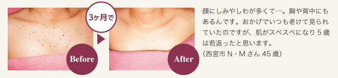 シミ撃退プログラム　お客様の声